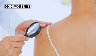 23 de mayo "D&iacute;a Mundial del Melanoma"