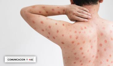 C&oacute;mo se contagia la viruela del mono: s&iacute;ntomas y prevenci&oacute;n