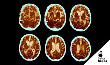 Enfermedades neurodegenerativas: una creciente crisis global