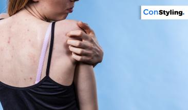 Los 3 errores que empeoran el acné en la espalda y cómo prevenirlo Los 3 errores que empeoran el acné en la espalda y cómo prevenirlo